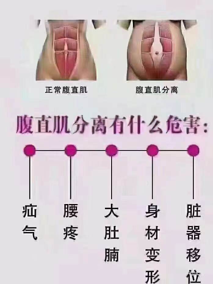 腹直肌修复一定不要等：