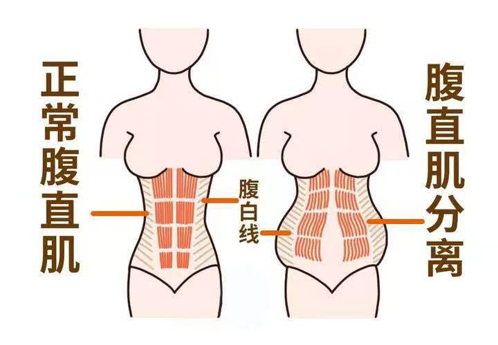盆底肌重要,腹直肌也不能忽视哦……我们腹...