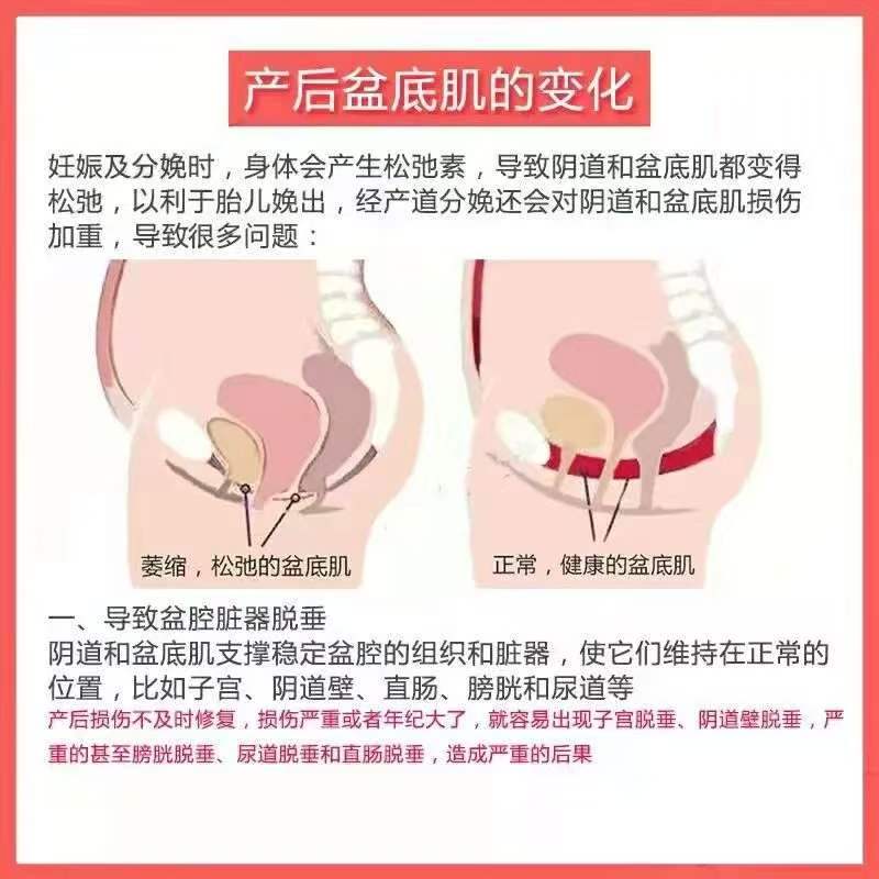 产后修复宜早不宜迟,早做早恢复