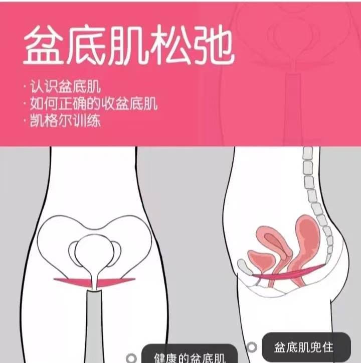 1⃣什么是盆底肌松弛