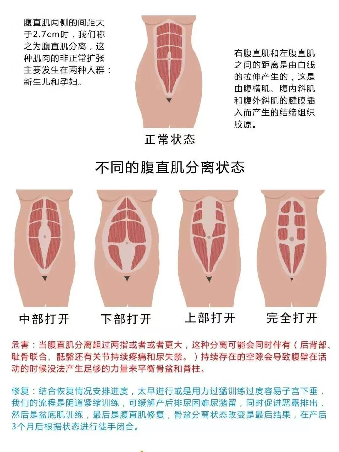 产后腹直肌最佳恢复期