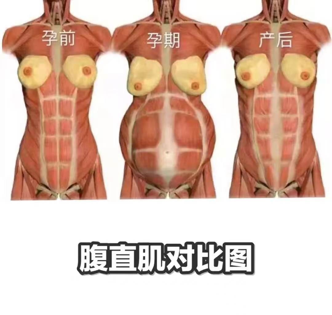 腹直肌分离有什么危害?