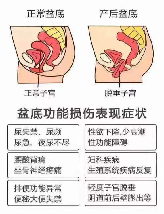 产后1年了,还能做盆底肌修复吗?
