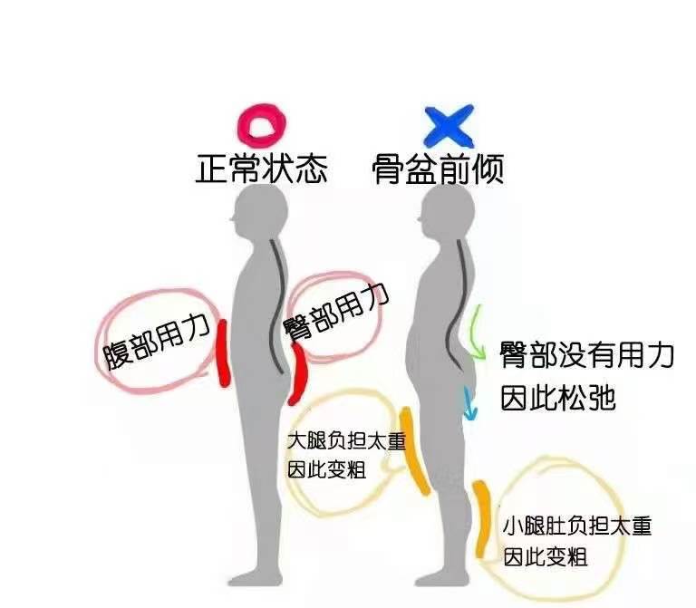下肢常见问题:骨盆前倾又称为下交叉综合症...