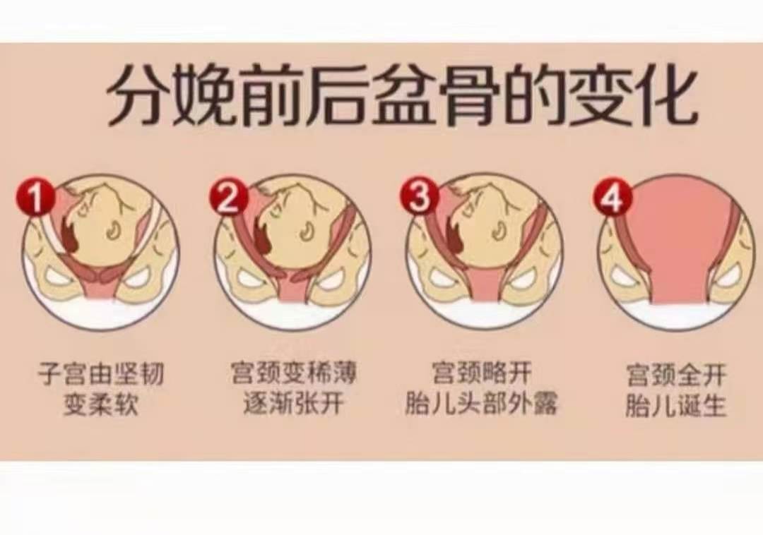 骨盆修复』 不只为了美,为了瘦,更是