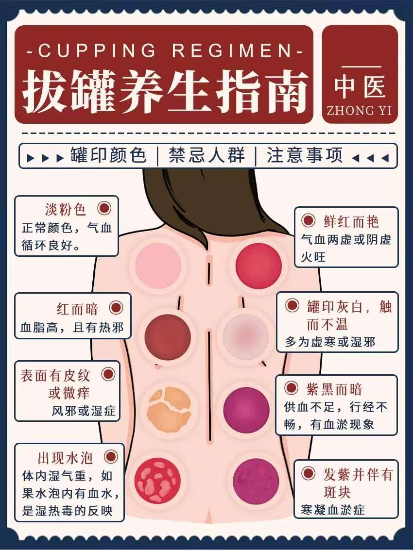 拔罐养生指南:罐印颜色/禁忌人群/注意事...