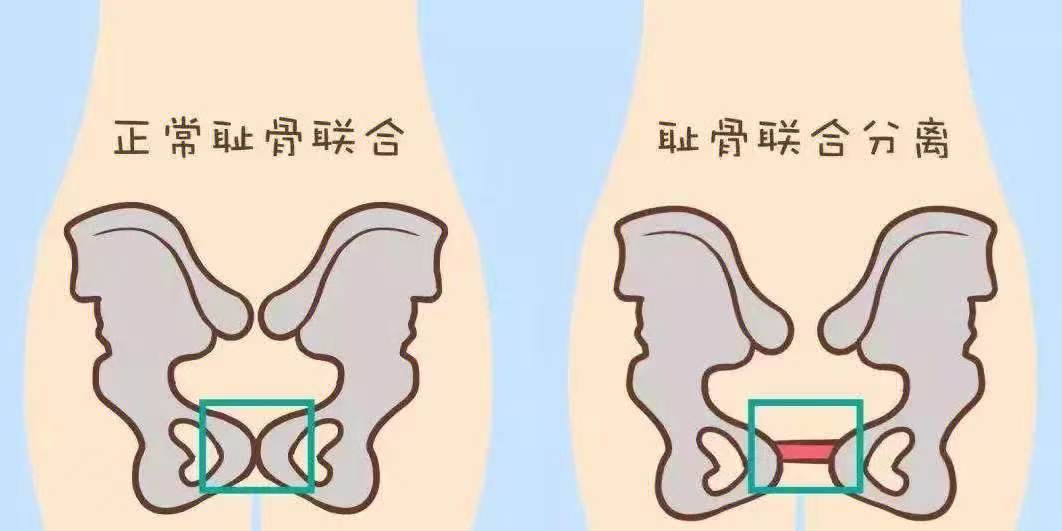 为什么说需要做骨盆修复。麻麻们十月怀胎,...