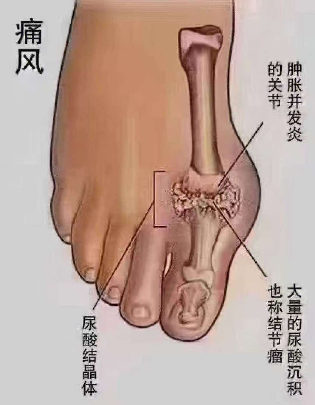 科普一下痛风:
