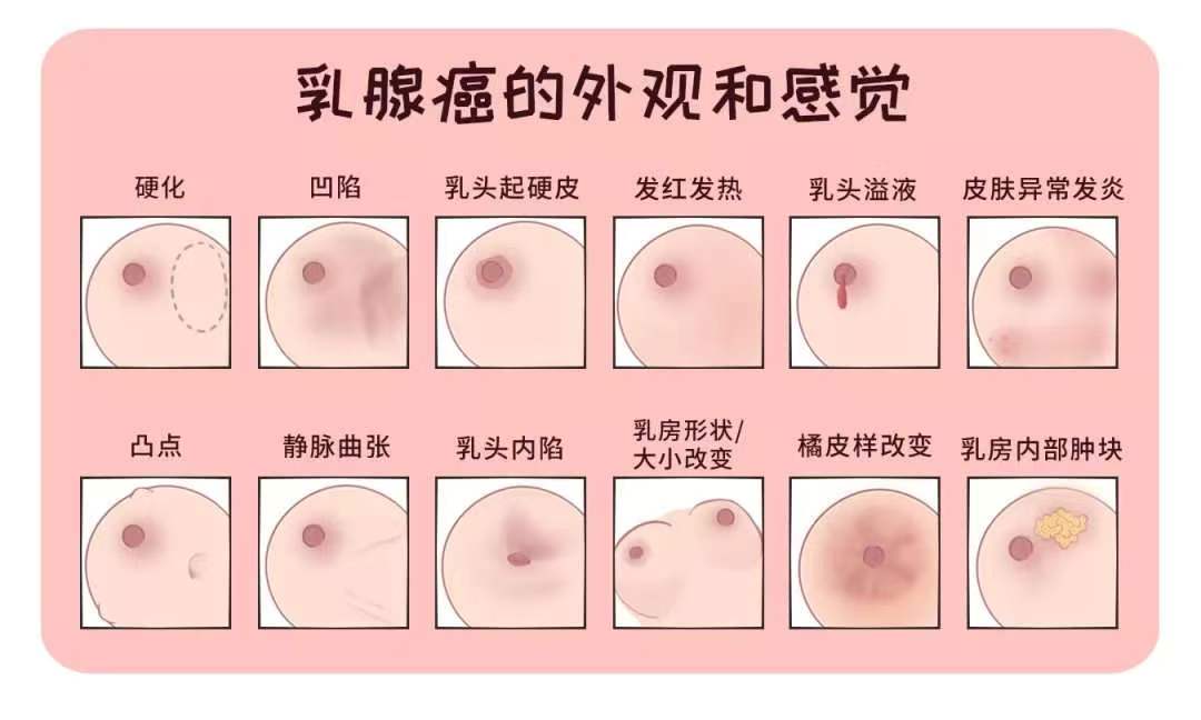 乳房疼痛是大众对乳腺癌的一个常见的误...