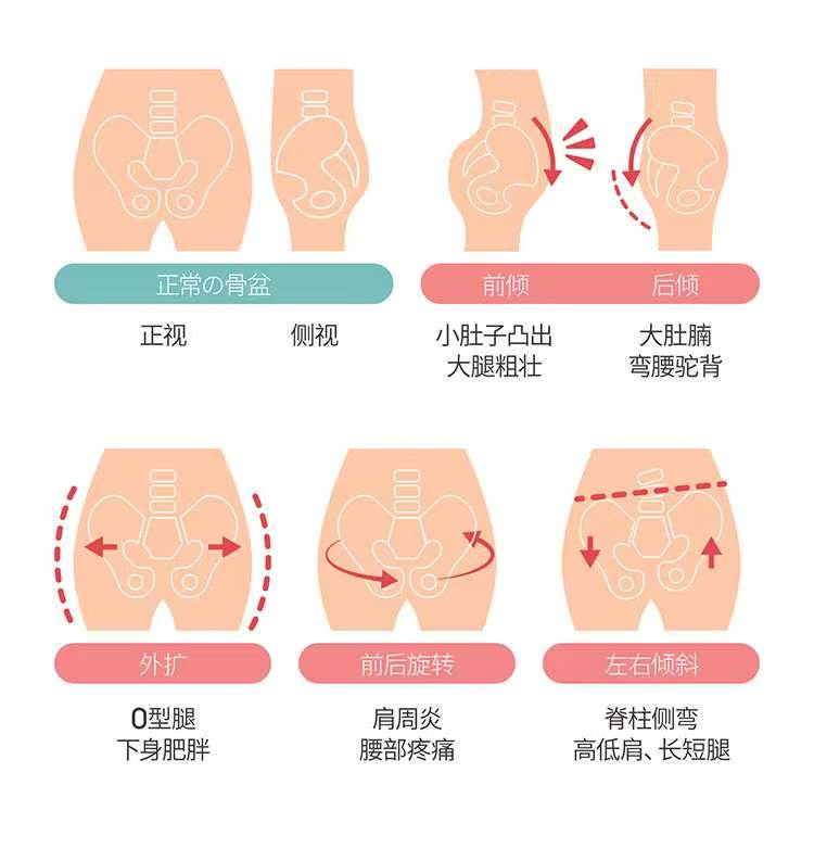 骨盆修复+盆底肌修复是一个宜早不宜晚的项...