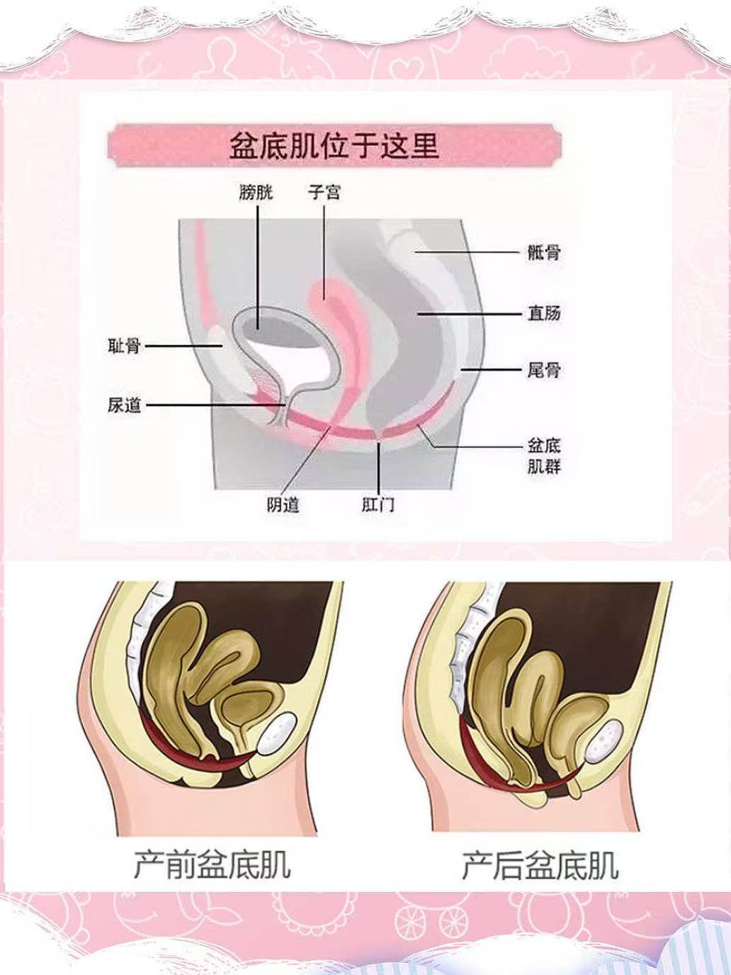 重视盆底肌修复,拒绝产后盆底肌后遗症