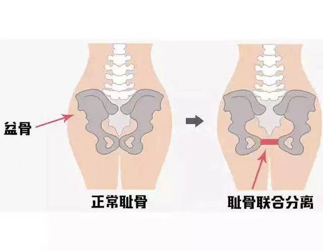 有一种痛叫做“耻骨联合分离痛”