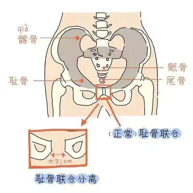 盆底科普-耻骨联合分离